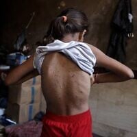 Une fillette gazaouie déplacée, qui, selon des médecins, souffre de la varicelle, à l'intérieur de la tente familiale, à Khan Younès, dans le sud de la bande de Gaza, le 19 juillet 2026. (Crédit : Bashar Taleb/AFP)