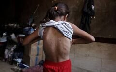 Une fillette gazaouie déplacée, qui, selon des médecins, souffre de la varicelle, à l'intérieur de la tente familiale, à Khan Younès, dans le sud de la bande de Gaza, le 19 juillet 2026. (Crédit : Bashar Taleb/AFP)