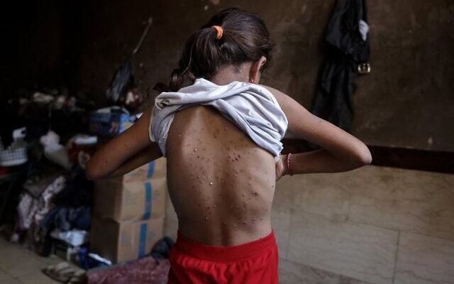 Une fillette gazaouie déplacée, qui, selon des médecins, souffre de la varicelle, à l'intérieur de la tente familiale, à Khan Younès, dans le sud de la bande de Gaza, le 19 juillet 2026. (Crédit : Bashar Taleb/AFP)