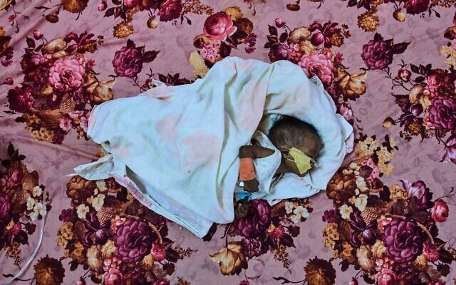 PHOTO D'ARCHIVES - Le patient Saidal Altaher, âgé de 2 mois, est soigné pour malnutrition au centre de stabilisation de l'hôpital pédiatrique de Port-Soudan, au Soudan, le mercredi 15 avril 2026. (Crédit : AP/Bernat Armangue, Archives)