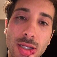 Tomer Eyal, blessé après une attaque antisémite dans le Val-d’Oise, le 7 août 2026. (Crédit : Tomer Eyal)
