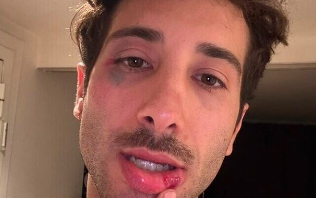 Tomer Eyal, blessé après une attaque antisémite dans le Val-d’Oise, le 7 août 2026. (Crédit : Tomer Eyal)
