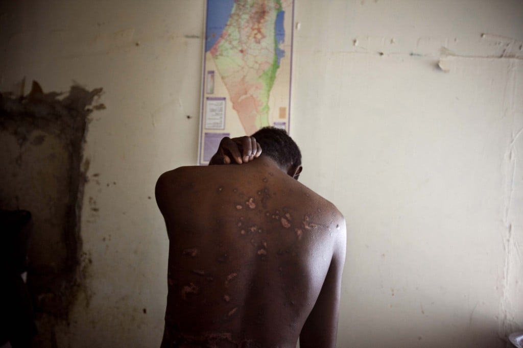 Sudanese Mutasim Qamrawi, 22, shows his scars from four months he was held in captivity by smugglers in Egypt's Sinai desert (photo credit: AP Photo/Oded Balilty) Sudanese Mutasim Qamrawi, 22, shows his scars from four months he was held in captivity by smugglers in Egypt's Sinai desert (photo credit: AP Photo/Oded Balilty)