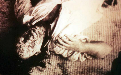 A young woman's facial skin is melted off during the Hiroshima bombing in 1945 (photo credit: Unknown)