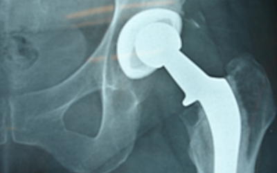 View of a hip with an implant made of MMATech's MP-1 material (Photo credit: Courtesy)
