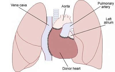 Heart transplant diagram (photo credit: CC-BY-SA NIH)