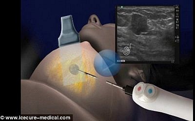 IceCure Medical uses a super-cooled needle to turns tumors into a ball of ice. (photo: courtesy/IceCure Medical)