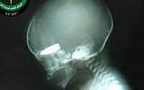 An x-ray image showing a fetus with what looks to be a bullet in its head. (Photo credit: Aleppo City Medical Council)