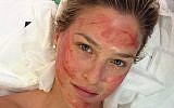 Bar Refaeli undergoing vampire facelift procedure (Instagram)
