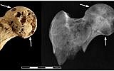 Image showing lesions thought to have been caused by cancer on the bones of a Sudanese man buried in 1200 BC. (photo credit: CC BY Binder et al/PLOS One)