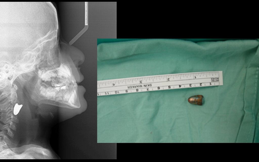 Instead of exiting through the boy’s cheek, the bullet lodged itself next to crucial blood vessels, endangering his life. In a dramatic operation, the doctors excised the bullet, without damaging the boy. (photo: Courtesy)