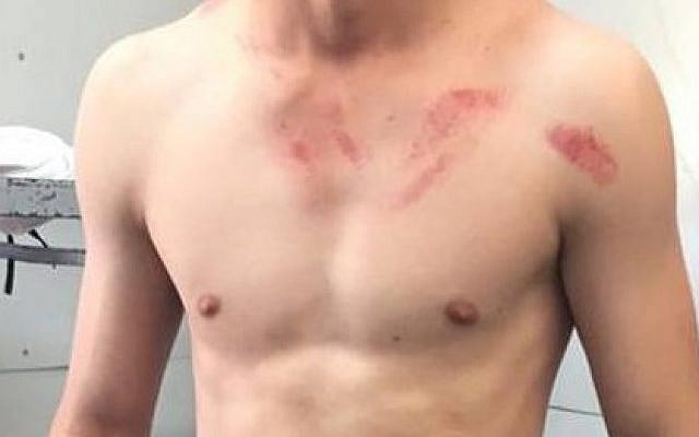 The injuries sustained by an unnamed Christian Arab Israeli soldier who was attacked on July 12, 2015, by Arabs for serving in the IDF. (Israeli Christians Recruitment Forum) The injuries sustained by an unnamed Christian Arab Israeli soldier who was attacked on July 12, 2015, by Arabs for serving in the IDF. (Israeli Christians Recruitment Forum)