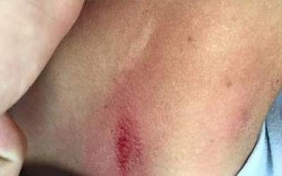 The injuries sustained by an unnamed Christian Arab Israeli soldier who was attacked on July 12, 2015 by Arabs for serving in the IDF. ( The Forum for Drafting the Christian Community)