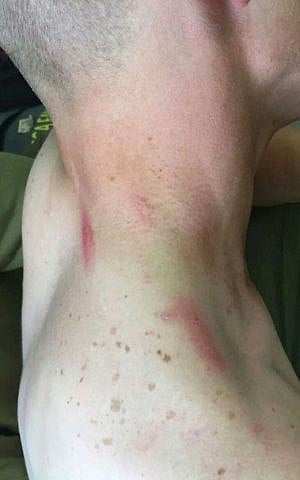 The injuries sustained by an unnamed Christian Arab Israeli soldier who was attacked on July 12, 2015 by Arabs for serving in the IDF. ( The Forum for Drafting the Christian Community)