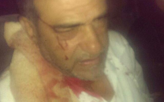 Imaad Abu Sharekh after being assaulted outside his home in Lod on August 2, 2015. Abu Sharekh claimed that the assailants were Jews, but Lod police claimed that the assailants were Arabs. (Courtesy) Imaad Abu Sharekh after being assaulted outside his home in Lod on August 2, 2015. Abu Sharekh claimed that the assailants were Jews, but Lod police claimed that the assailants were Arabs. (Courtesy)