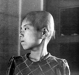 Aiko Ikemoto suffers hair loss after exposure to radiation in Hiroshima. The 11-year-old was on the second floor of a wooden house at about a mile from the epicenter. As a result of the radiation, hair loss began, followed by fever, loss of appetite and gum bleeding. She gradually recovered. (Shunkichi Kikuchi/Government of Japan/Wikimedia Commons) Aiko Ikemoto suffers hair loss after exposure to radiation in Hiroshima. The 11-year-old was on the second floor of a wooden house at about a mile from the epicenter. As a result of the radiation, hair loss began, followed by fever, loss of appetite and gum bleeding. She gradually recovered. (Shunkichi Kikuchi/Government of Japan/Wikimedia Commons)