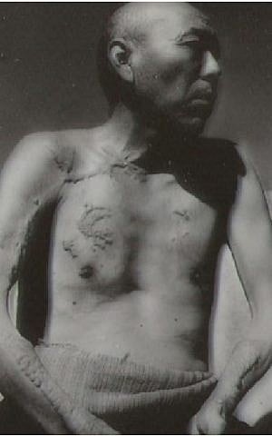 Japanese man with radiation-related injuries from atomic bombing during World War II. (US government/Wikimedia Commons) Japanese man with radiation-related injuries from atomic bombing during World War II. (US government/Wikimedia Commons)