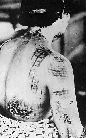 A Japanese casualty of the Hiroshima nuclear bomb. Her skin was burned in the same pattern as the kimono she was wearing at the time of the blast. (Wikimedia Commons) A Japanese casualty of the Hiroshima nuclear bomb. Her skin was burned in the same pattern as the kimono she was wearing at the time of the blast. (Wikimedia Commons)