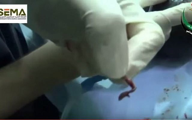 A doctor holds a piece of missile shrapnel pulled from the brow of newborn Syrian baby girl who was injured while still in her mother's womb. (YouTube/ABC News Australia) A doctor holds a piece of missile shrapnel pulled from the brow of newborn Syrian baby girl who was injured while still in her mother's womb. (YouTube/ABC News Australia)