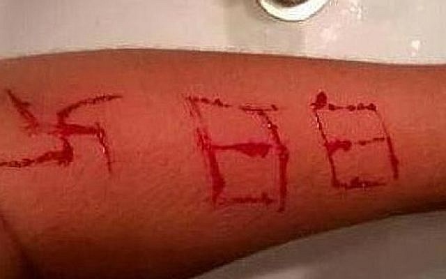 An image of the swastika and "88" a Spanish teenager said were carved into his arm by neo-Nazis, using a razor. An image of the swastika and "88" a Spanish teenager said were carved into his arm by neo-Nazis, using a razor.