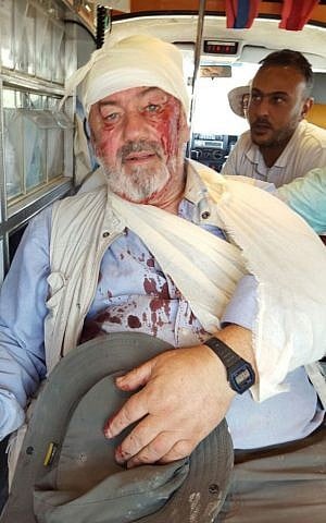 A British national allegedly injured in an altercation between settlers and Palestinians in the West Bank on Wednesday, October 14, 2015 (Rabbis for Human Rights)