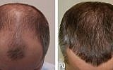Illustrative before and after pictures of a hair transplantation procedure. (Jerzy Kolasiński/Wikimedia Commons)