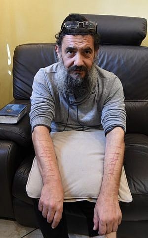 This file photo taken on November 19, 2015 shows Tsion Sa'adoun, a teacher at a Jewish school who claimed he was attacked on November 18, 2015 by Islamic State jihadists, lifting his shirt to show his wounds at his home in Marseille. (Boris Horvat/AFP)