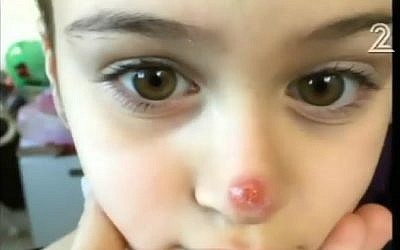 Sapir Perlamuter of the Tzofim settlement in the West Bank was bitten by a sandfly in November 2015. (Screenshot/Channel 2) Sapir Perlamuter of the Tzofim settlement in the West Bank was bitten by a sandfly in November 2015. (Screenshot/Channel 2)