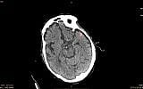 Picture of Israel's MedyMatch stroke assessment. (Courtesy)