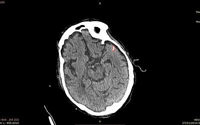 Picture of Israel's MedyMatch stroke assessment. (Courtesy)