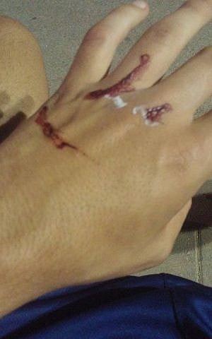 Injuries to the hand of a Jewish teenager attacked by an Arab gang in south Tel Aviv, June 21, 2016. (Facebook/Sahar Tusia)