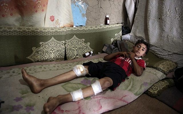 Bassam al-Habary, 13, who was injured when a bomb exploded killing his friend, 10-year-old Youssef al-Salmi, in Hasn Faj Attan village, on the mountainous outskirts of Sanaa, Yemen, seen here on July, 25, 2016. (AP Photo/Hani Mohammed)