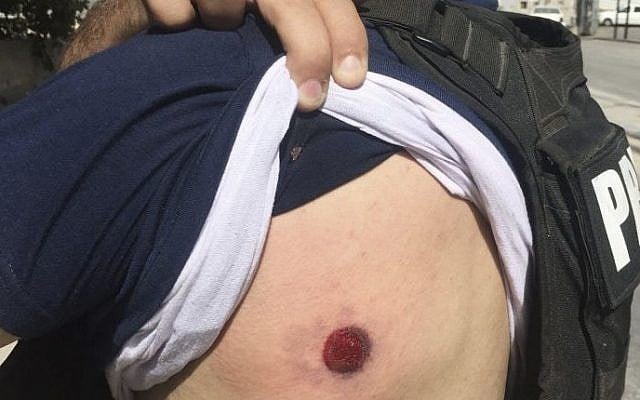 The Associated Press Photographer Majdi Mohammed shows a bruise after he was hit with a rubber bullet while covering clashes between Israeli forces and Palestinians in the town of al Ram, West Bank, October 9, 2016. (AP Photo) The Associated Press Photographer Majdi Mohammed shows a bruise after he was hit with a rubber bullet while covering clashes between Israeli forces and Palestinians in the town of al Ram, West Bank, October 9, 2016. (AP Photo)