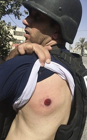 The Associated Press Photographer Majdi Mohammed shows a bruise after he was hit with a rubber bullet while covering clashes between Israeli forces and Palestinians in the town of al Ram, West Bank, October 9, 2016. (AP Photo) Associated Press photographer Majdi Mohammed shows a bruise after he was hit with a rubber bullet in the West Bank, October 9, 2016. (AP Photo)