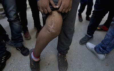 In this photo taken Thursday, Nov. 10, 2016, Palestinian Husein Abu Asab, 12 shows his wounded leg to journalists, that he says was sustained during the latest Palestinian police offensive in Balata refugee camp, in the West Bank. (AP Photo/Nasser Nasser)