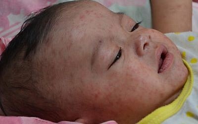 Illustrative: Baby suffering from measles (CC BY CDC Global, Flickr)
