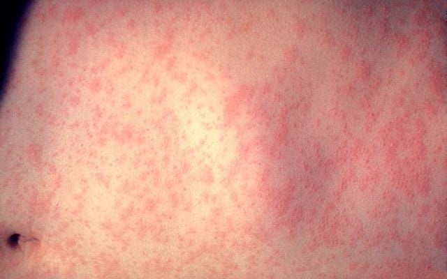 Illustrative photo, showing the skin of a person after days of measles infection. (Public domain/ US Department of Health and Human Services/Wikimedia) Illustrative photo, showing the skin of a person after days of measles infection. (Public domain/ US Department of Health and Human Services/Wikimedia)
