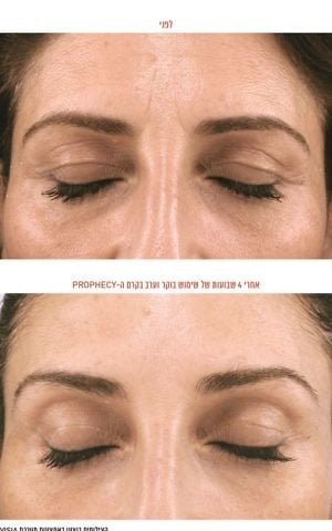 A before and after image of a model after four weeks of using the cream (Courtesy)