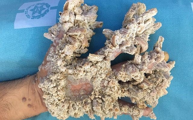 Gaza resident Mohammed Taluli's hand before it was operated on by doctors at Jerusalem's Hadassah Medical Center. (Hadassah Medical Center) Gaza resident Mohammed Taluli's hand before it was operated on by doctors at Jerusalem's Hadassah Medical Center. (Hadassah Medical Center)