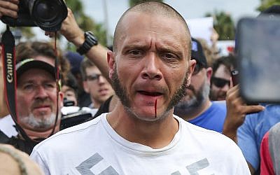 Blood runs from the lip of a man wearing a shirt with swastikas after he was punched by a protester outside a University of Florida auditorium where white nationalist Richard Spencer was preparing to speak on October 19, 2017 in Gainesville, Fla. (Will Vragovic/Tampa Bay Times via AP)