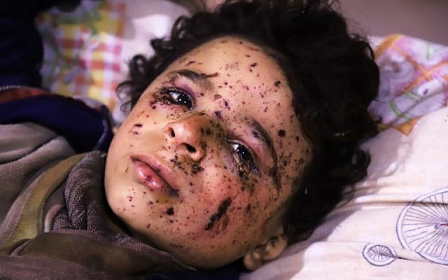 Ten-year-old Omar who was injured in an air strike, that killed several members of his family, on their home in Otaybah receives treatment at a make-shift hospital in Syria's rebel-held enclave of Eastern Ghouta, on February 25, 2018.  (AFP PHOTO / AMER ALMOHIBANY)