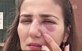 Tova Orlero shows the wounds she sustained in an assault by a man she honked at in the northern city of Afula on June 29, 2018. (Screen capture: Channel 10)