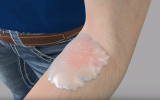 Researchers at Technion have cured fungal infections using a soil-dwelling bacteria which survive in a gel they have prepared; Technion University screenshot)