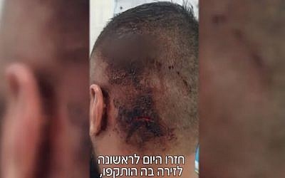 An injury suffered by one of three victims in an alleged attack by Jewish suspects on Arab residents of Shfaram near a Haifa beach on August 23, 2018. (Screenshot/Mako)