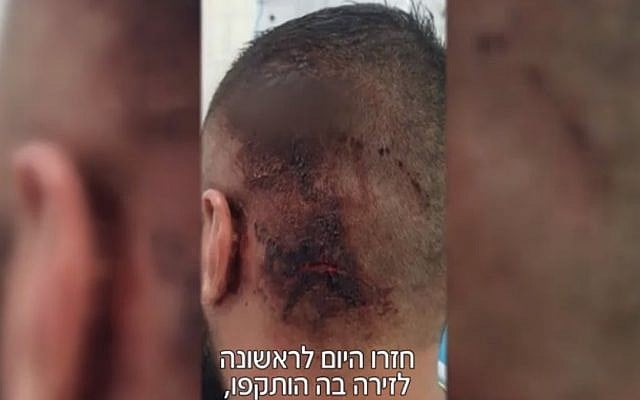 An injury suffered by one of three victims in an alleged attack by Jewish suspects on Arab residents of Shfaram near a Haifa beach on August 23, 2018. (Screenshot/Mako) An injury suffered by one of three victims in an alleged attack by Jewish suspects on Arab residents of Shfaram near a Haifa beach on August 23, 2018. (Screenshot/Mako)