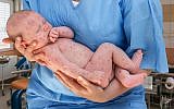 Newborn baby suffering from measles. (Illustrative, iStock by Getty Images/andriano_cz)