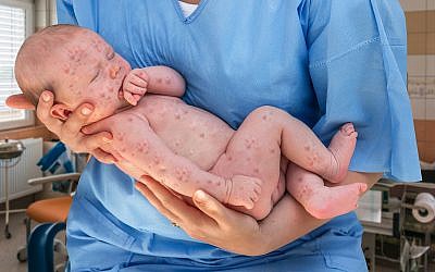Newborn baby suffering from measles. (Illustrative. iStock by Getty Images/andriano_cz)