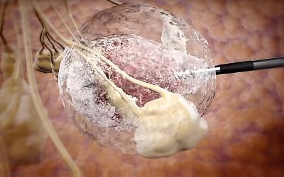 Illustration of how IceCure Medical's technology freezes tumors using a probe and extremely cold temperatures (Courtesy)