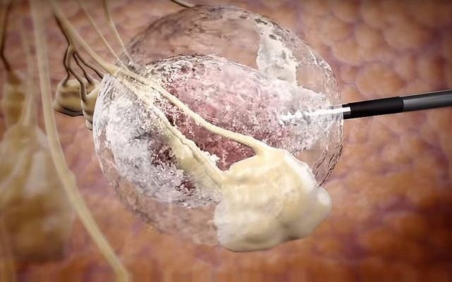 Illustration of how IceCure Medical's technology freezes tumors using a probe and extremely cold temperatures (Courtesy) Illustration of how IceCure Medical's technology freezes tumors using a probe and extremely cold temperatures (Courtesy)