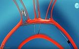 An illustration of how the TriGUARD 3 device, developed by Caesarea, Israel-based firm Keystone Heart Ltd. works (YouTube screenshot)